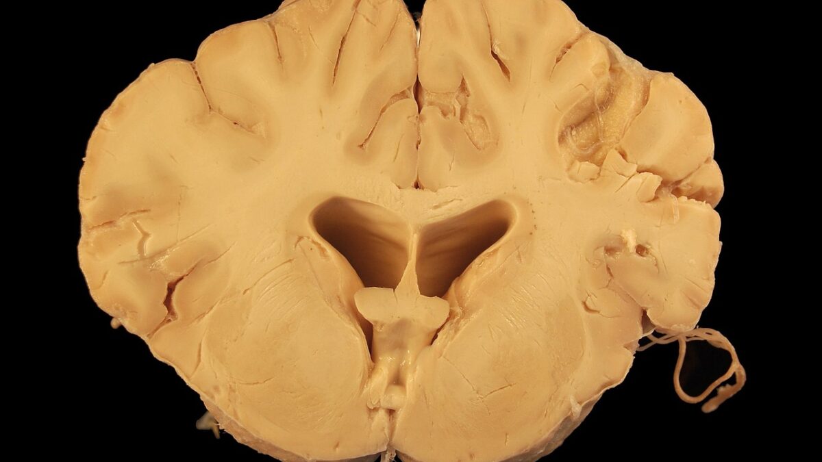 Coupe transversale d'un cerveau humain fixé, de couleur beige, posé sur fond noir, montrant la substance blanche, la substance grise, les ventricules latéraux et des structures médianes.